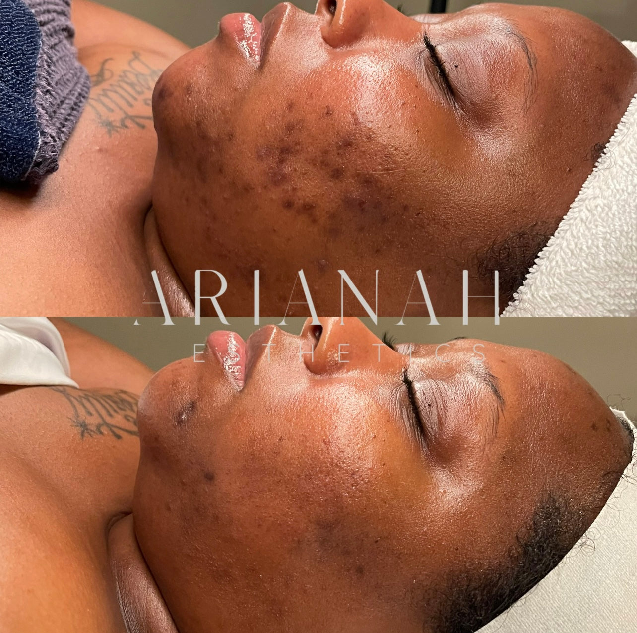 The Acne Reset Program